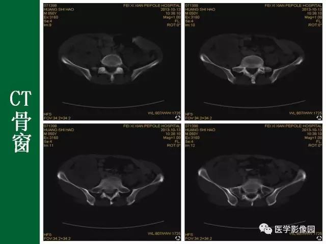 【病例】阑尾粘液腺癌1例CT 【病例】阑尾粘液腺癌1例CT