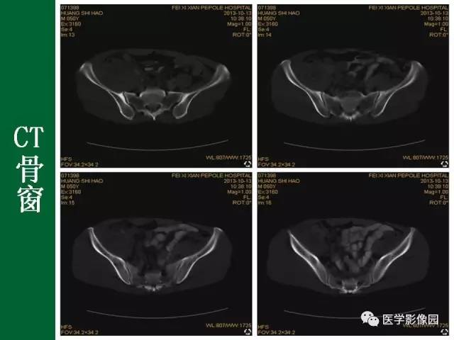 【病例】阑尾粘液腺癌1例CT 【病例】阑尾粘液腺癌1例CT
