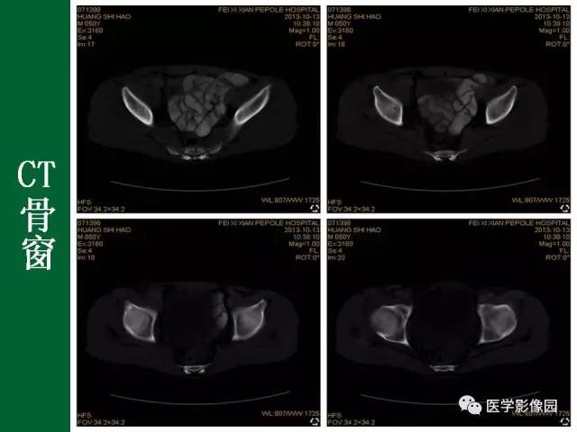 【病例】阑尾粘液腺癌1例CT 【病例】阑尾粘液腺癌1例CT