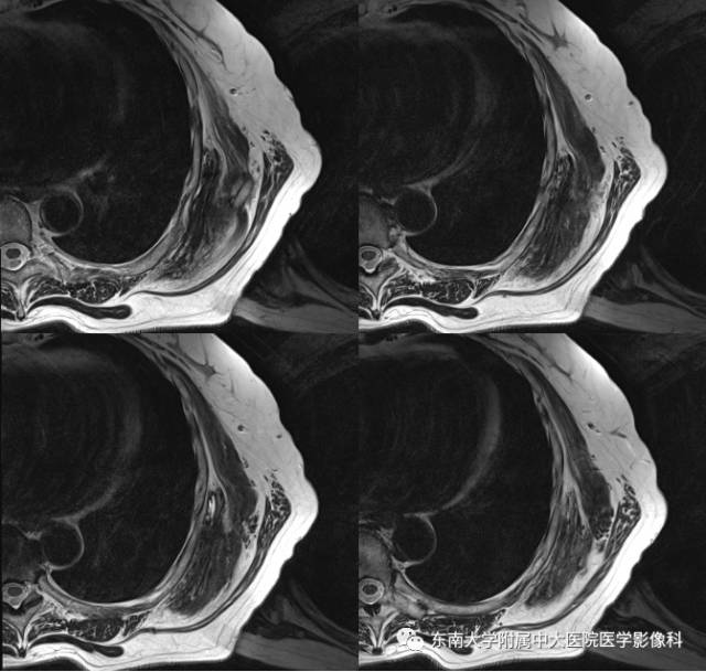 【病例】左侧胸壁弹力纤维瘤1例CT及MR影像诊断