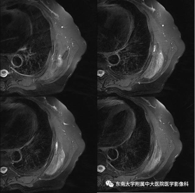 【病例】左侧胸壁弹力纤维瘤1例CT及MR影像诊断
