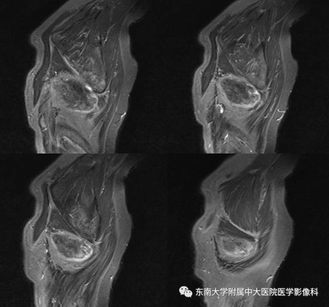 【病例】左侧胸壁弹力纤维瘤1例CT及MR影像诊断