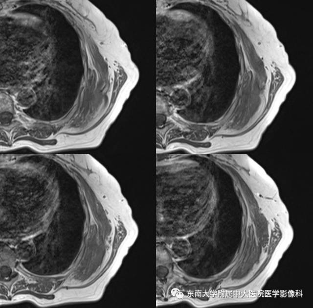 【病例】左侧胸壁弹力纤维瘤1例CT及MR影像诊断