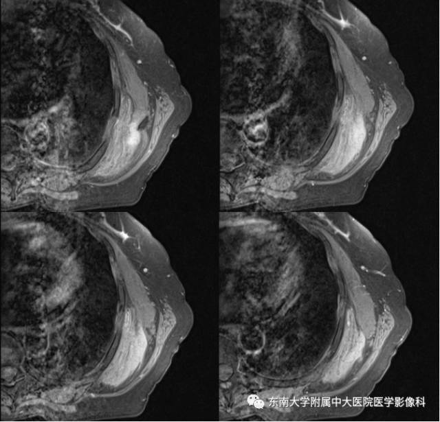 【病例】左侧胸壁弹力纤维瘤1例CT及MR影像诊断