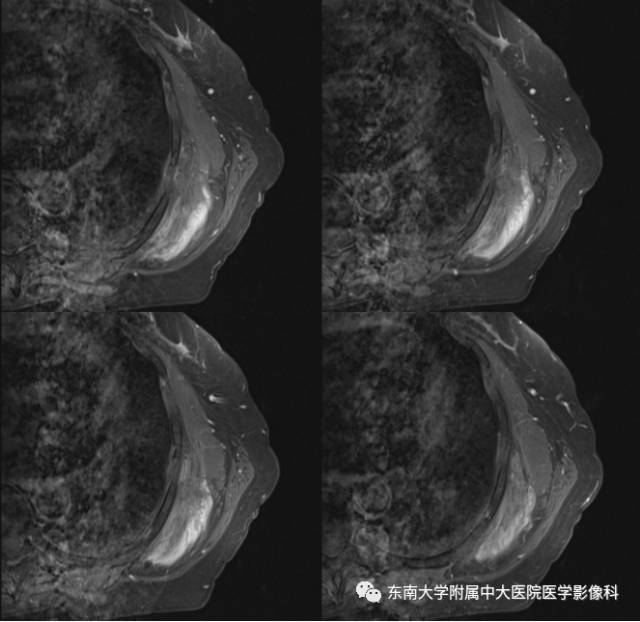 【病例】左侧胸壁弹力纤维瘤1例CT及MR影像诊断