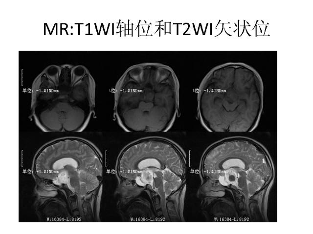 【病例】鞍上、三脑室区脊索样胶质瘤一例CT及MR影像讨论