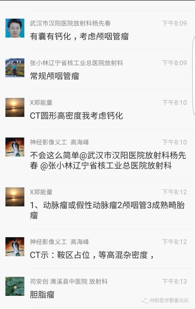 【病例】鞍上、三脑室区脊索样胶质瘤一例CT及MR影像讨论
