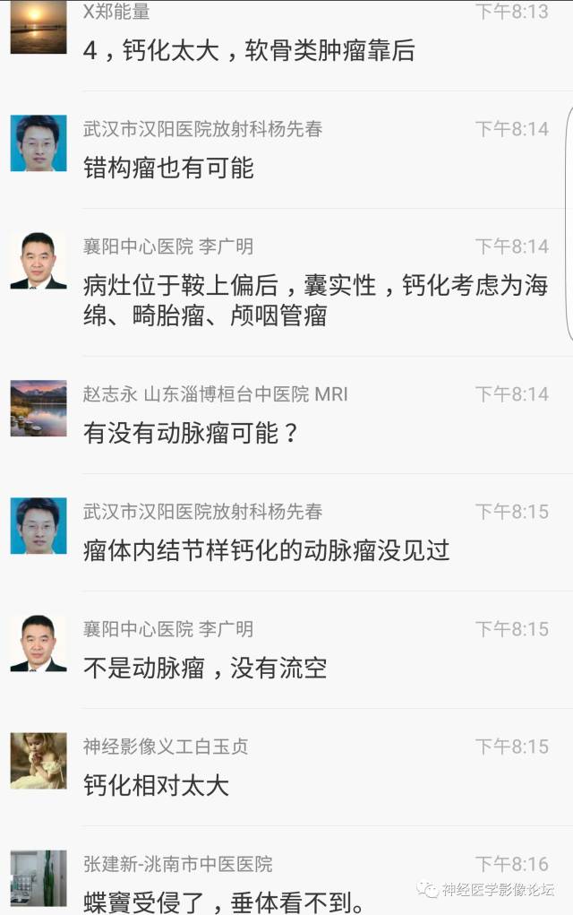 【病例】鞍上、三脑室区脊索样胶质瘤一例CT及MR影像讨论