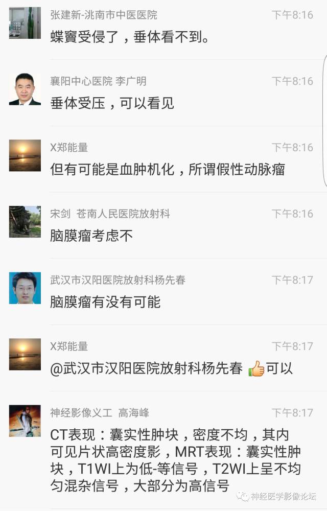 【病例】鞍上、三脑室区脊索样胶质瘤一例CT及MR影像讨论