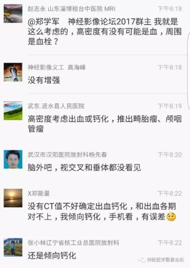 【病例】鞍上、三脑室区脊索样胶质瘤一例CT及MR影像讨论