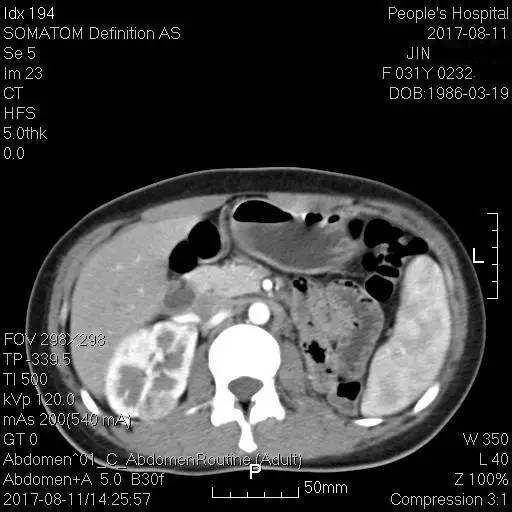 【病例】肺淋巴管肌瘤病(结节性硬化)1例 【病例】肺淋巴管肌瘤病(结节性硬化)1例