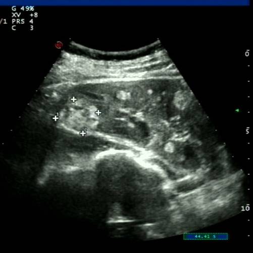 【病例】肺淋巴管肌瘤病(结节性硬化)1例 【病例】肺淋巴管肌瘤病(结节性硬化)1例