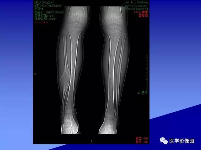 【病例】腓骨骨纤维异常增殖症1例X线CT影像表现