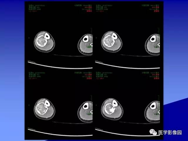 【病例】腓骨骨纤维异常增殖症1例X线CT影像表现 【病例】腓骨骨纤维异常增殖症1例X线CT影像表现