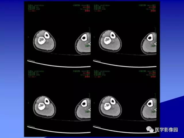 【病例】腓骨骨纤维异常增殖症1例X线CT影像表现 【病例】腓骨骨纤维异常增殖症1例X线CT影像表现