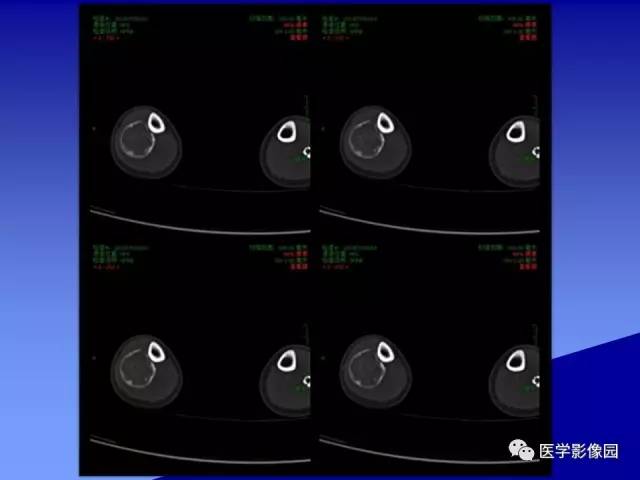 【病例】腓骨骨纤维异常增殖症1例X线CT影像表现 【病例】腓骨骨纤维异常增殖症1例X线CT影像表现