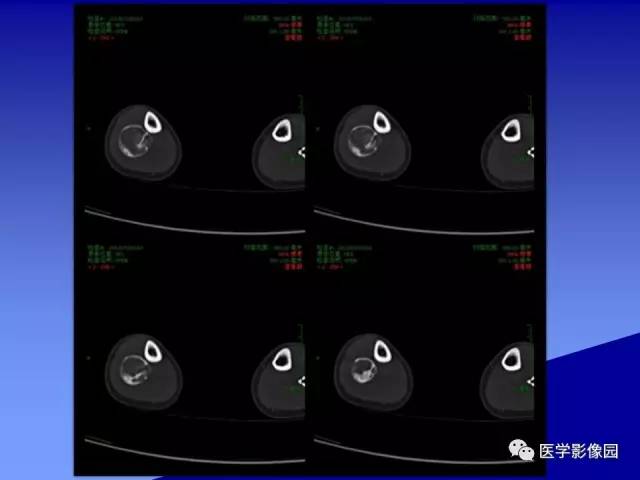 【病例】腓骨骨纤维异常增殖症1例X线CT影像表现 【病例】腓骨骨纤维异常增殖症1例X线CT影像表现