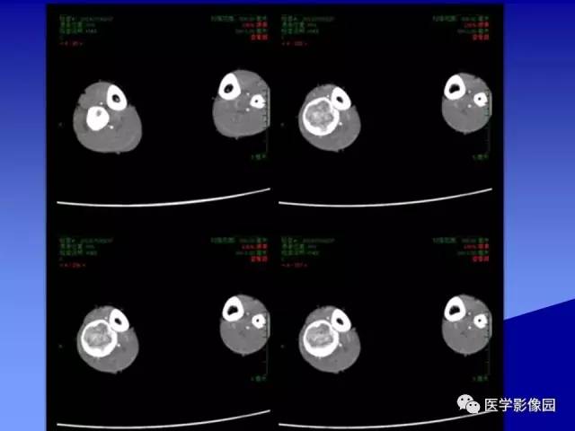 【病例】腓骨骨纤维异常增殖症1例X线CT影像表现 【病例】腓骨骨纤维异常增殖症1例X线CT影像表现