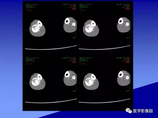 【病例】腓骨骨纤维异常增殖症1例X线CT影像表现 【病例】腓骨骨纤维异常增殖症1例X线CT影像表现