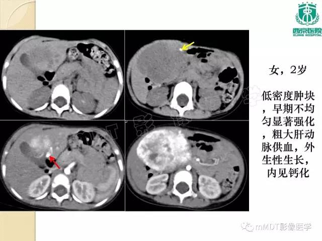 【PPT】儿童肝脏肿瘤