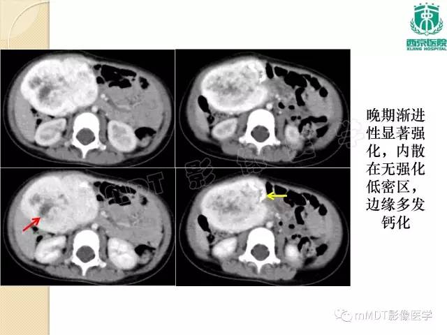 【PPT】儿童肝脏肿瘤