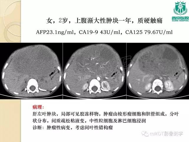 【PPT】儿童肝脏肿瘤