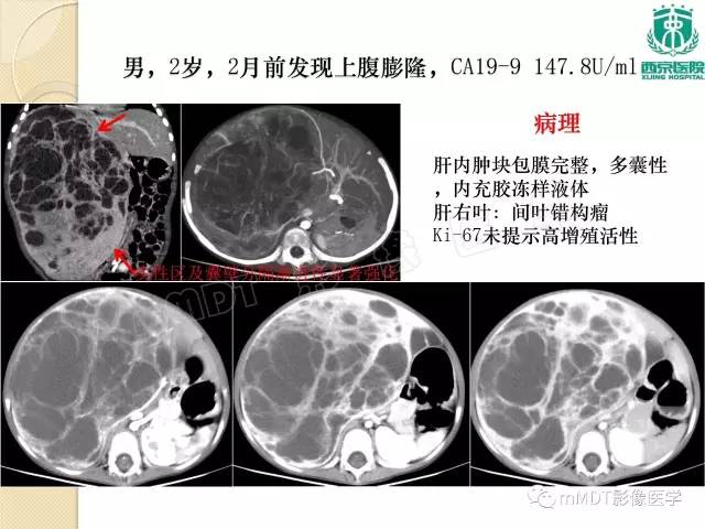【PPT】儿童肝脏肿瘤