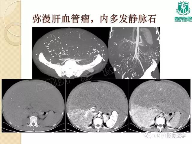 【PPT】儿童肝脏肿瘤