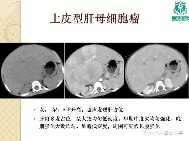 【PPT】儿童肝脏肿瘤