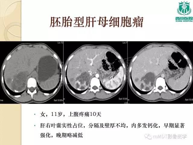 【PPT】儿童肝脏肿瘤
