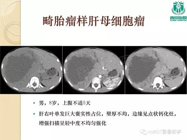 【PPT】儿童肝脏肿瘤
