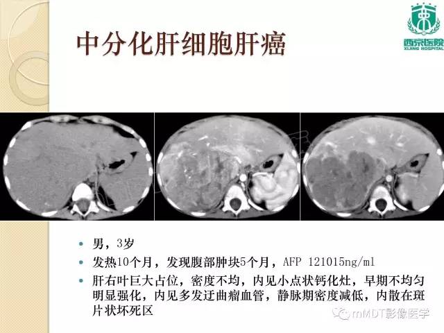 【PPT】儿童肝脏肿瘤