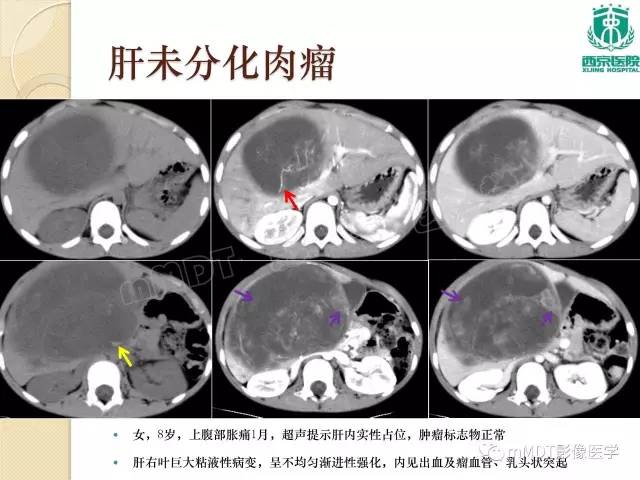 【PPT】儿童肝脏肿瘤