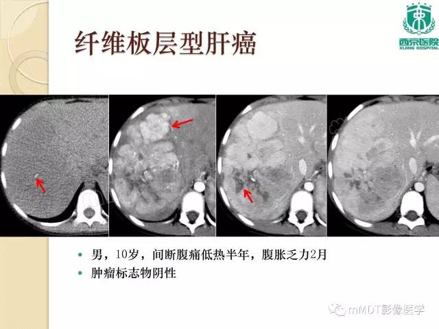 【PPT】儿童肝脏肿瘤