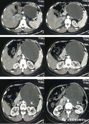 【病例】胰体尾粘液性囊腺瘤1例CT影像表现