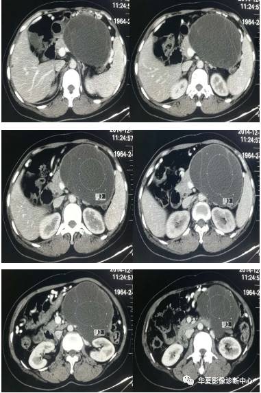 【病例】胰体尾粘液性囊腺瘤1例CT影像表现 【病例】胰体尾粘液性囊腺瘤1例CT影像表现