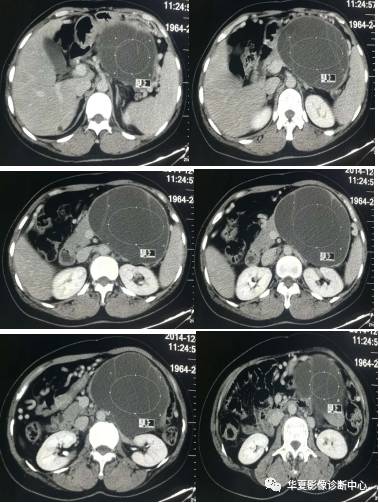 【病例】胰体尾粘液性囊腺瘤1例CT影像表现 【病例】胰体尾粘液性囊腺瘤1例CT影像表现