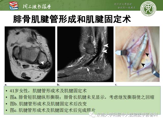 【PPT】踝及足术后CT和MR成像