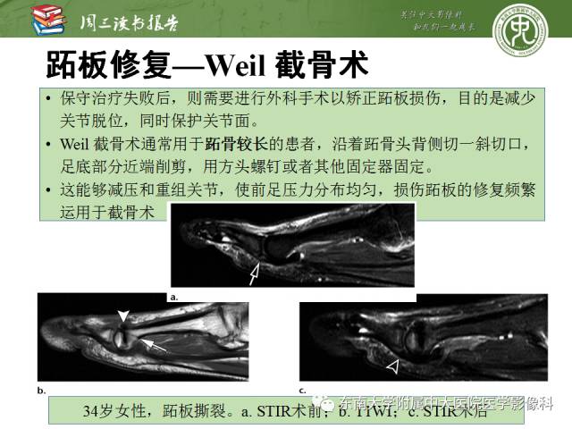 【PPT】踝及足术后CT和MR成像