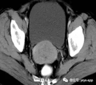 【病例】宫颈癌1例CT及MR影像诊断分析 【病例】宫颈癌1例CT及MR影像诊断分析