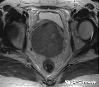 【病例】宫颈癌1例CT及MR影像诊断分析 【病例】宫颈癌1例CT及MR影像诊断分析