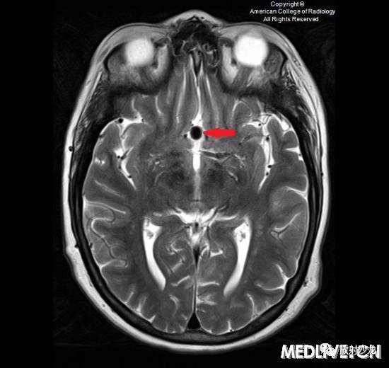 【病例】前交通动脉瘤1例CT影像表现 【病例】前交通动脉瘤1例CT影像表现