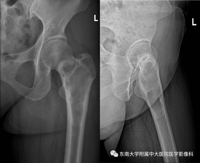 【病例】左股骨骨纤维异常增殖症1例X线CT影像诊断