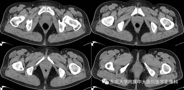 【病例】左股骨骨纤维异常增殖症1例X线CT影像诊断