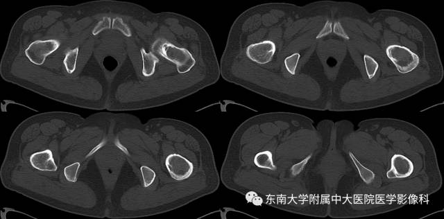 【病例】左股骨骨纤维异常增殖症1例X线CT影像诊断