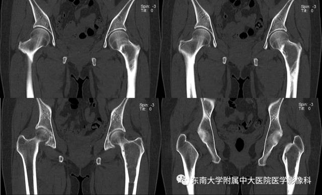 【病例】左股骨骨纤维异常增殖症1例X线CT影像诊断