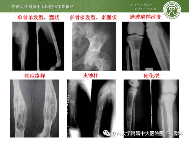【病例】左股骨骨纤维异常增殖症1例X线CT影像诊断