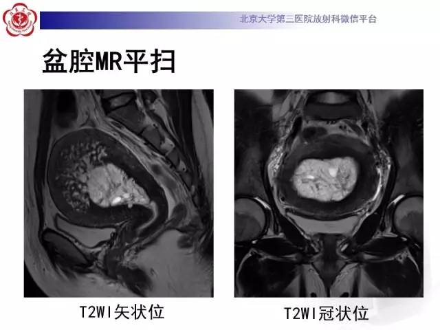 【病例】子宫内膜息肉2例MR影像诊断