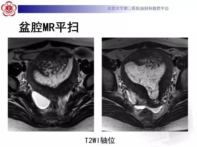【病例】子宫内膜息肉2例MR影像诊断