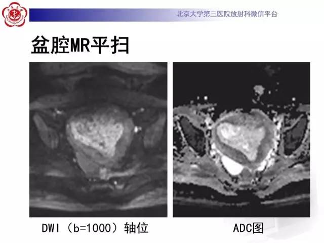 【病例】子宫内膜息肉2例MR影像诊断